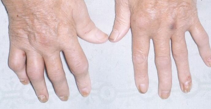 psoriasis arthropathique dans les mains