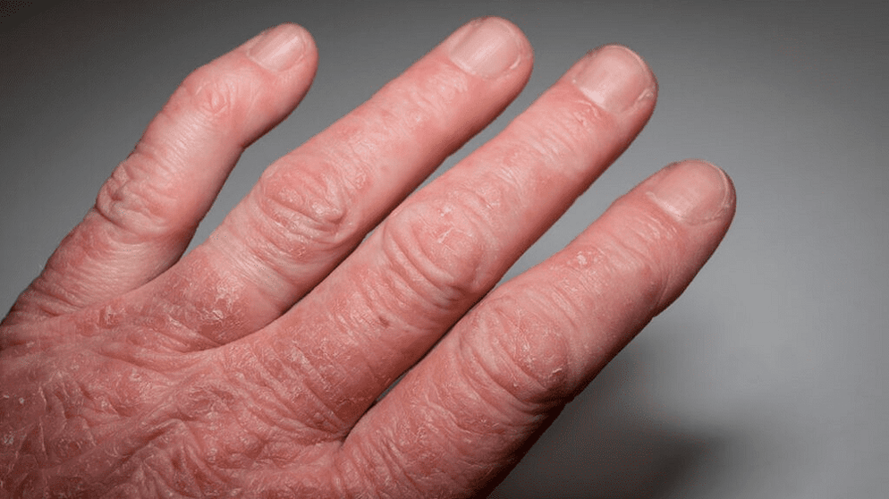 rhumatisme psoriasique des mains