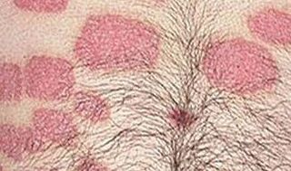 Plus de formations roses sur l'abdomen