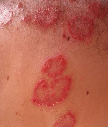 Repas de psoriasis