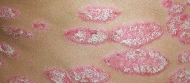 La phase progressive du psoriasis