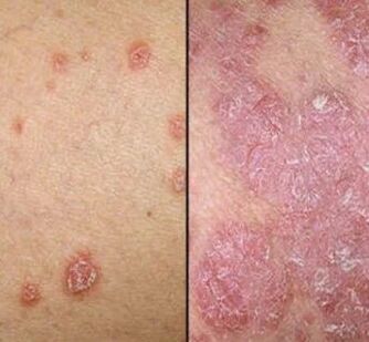 Plaques psoriaux