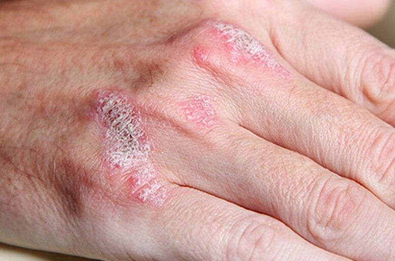 Psoriasis de ladomaria-contentuta