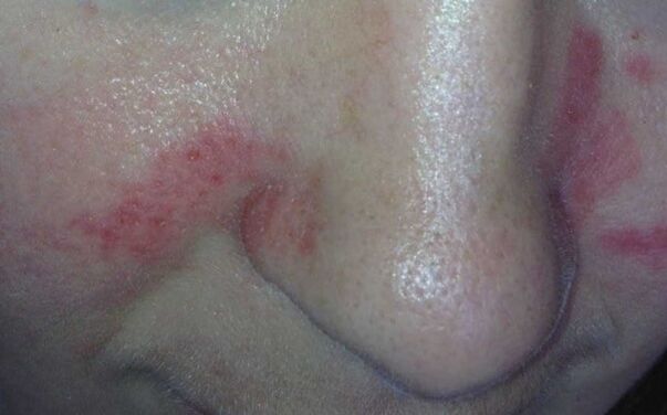 Symptômes du psoriasis sur le visage