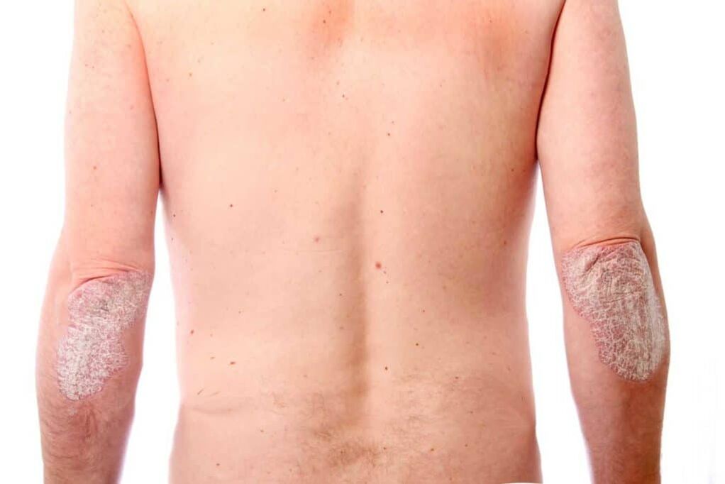 La deuxième phase du psoriasis