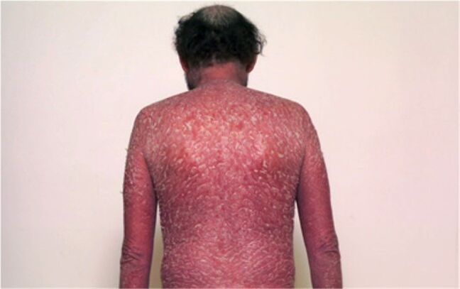La troisième phase du psoriasis