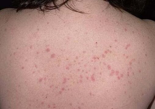 La phase initiale du psoriasis