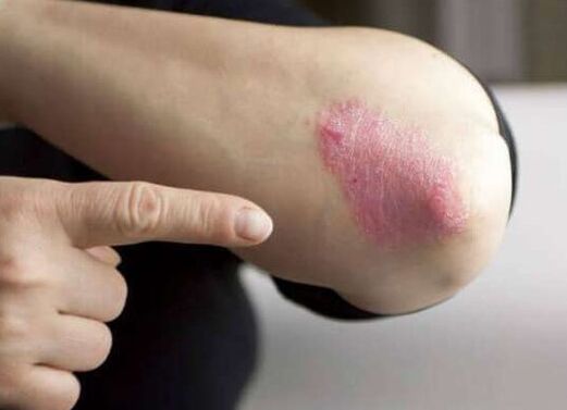 La phase stationnaire du psoriasis