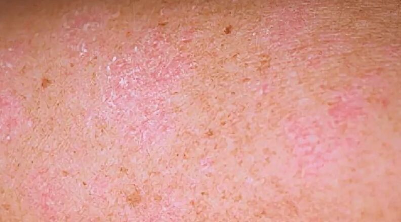 Le stade régressif du psoriasis