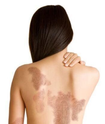 Phase du psoriasis en fonction de la zone de blessure