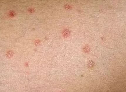 Psoriasis de la phase initiale
