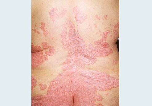 Psoriasis de la partie arrière