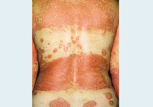 Psoriasis génital
