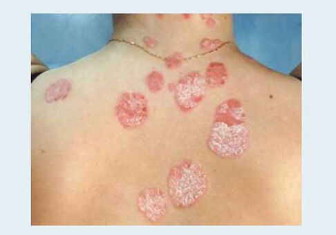 Psoriasis ordinaire
