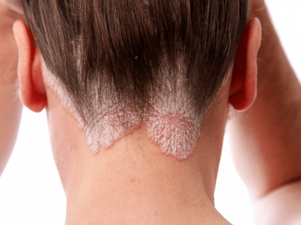 Psoriasis sur la tête