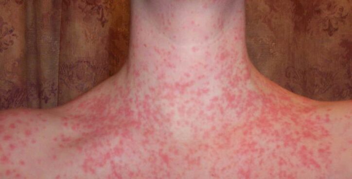 Psoriasis sur le corps