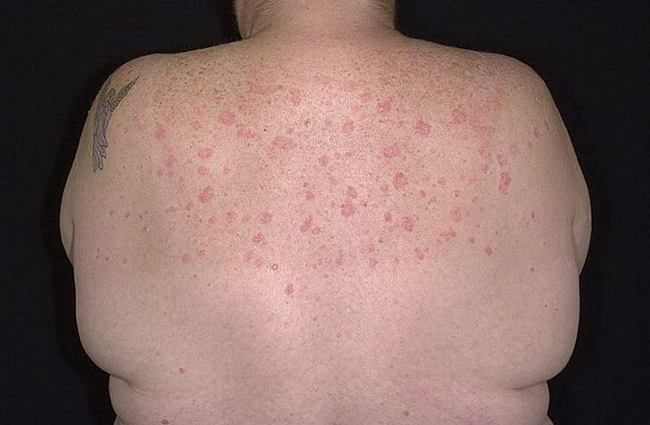 Psoriasis sur les épaules