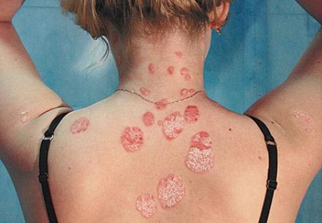 Psoriasis à l'arrière