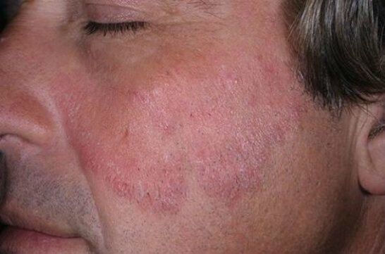 Sur le visage