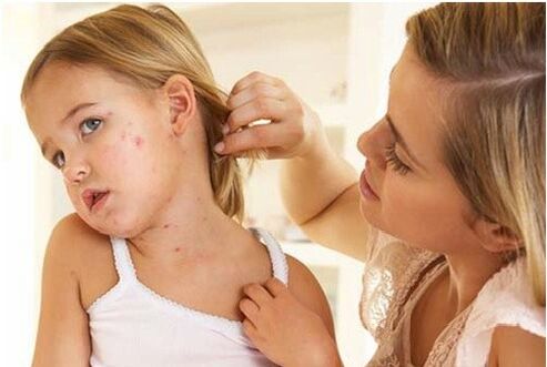 Photos de la phase initiale du psoriasis