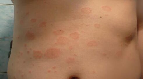 Psoriasis de la phase initiale