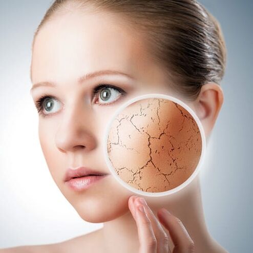 Psoriasis sur le visage