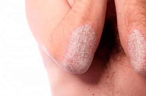 Psoriasis sur les coudes