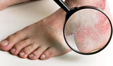 options de traitement du psoriasis