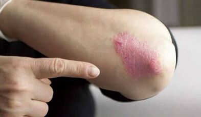 phase stationnaire du développement du psoriasis