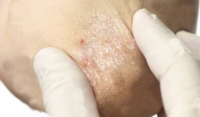 traitement du psoriasis en phase d'atténuation