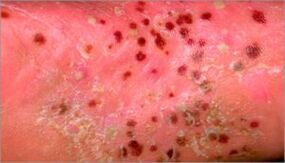 Psoriasis pustuleux