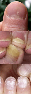 Nail psoriasis - phase initiale