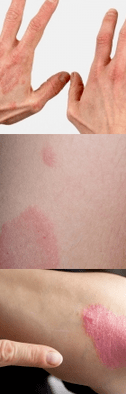 Psoriasis de la phase initiale sur les mains
