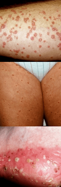 Psoriasis sur les jambes