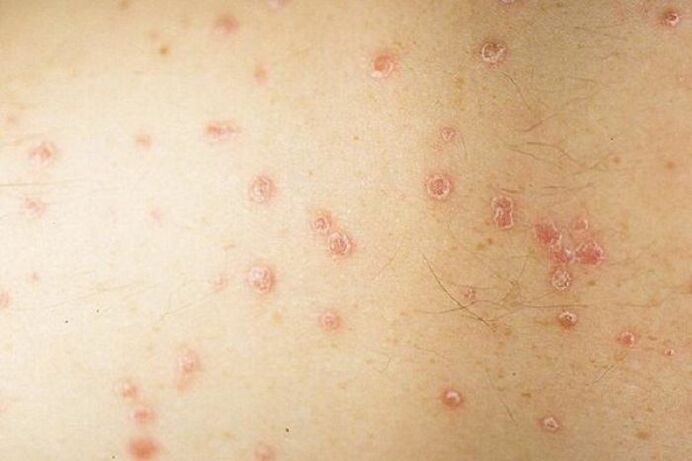 Symptômes localisés du psoriasis