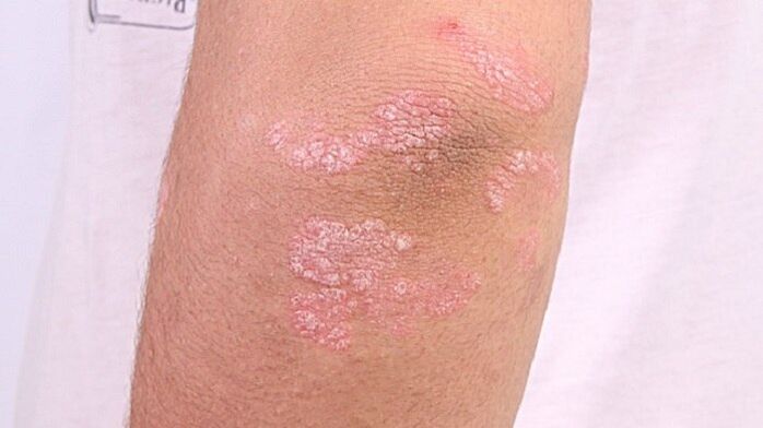 photo d'un psoriasis à un stade précoce