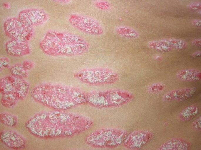 psoriasis en plaques