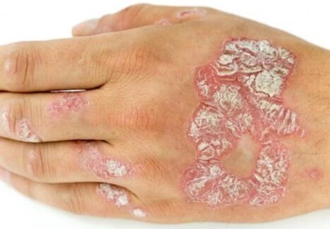 le psoriasis à portée de main