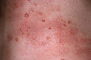 photo du psoriasis sur la peau